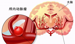【欽二醫(yī)技術(shù)】神經(jīng)介入團(tuán)隊(duì)，行走在腦血管上的“拆彈”專家