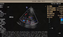 【欽二醫(yī)技術(shù)】腦卒中防治的“偵察兵”——心臟及頸、腦動(dòng)脈一體化超聲檢查